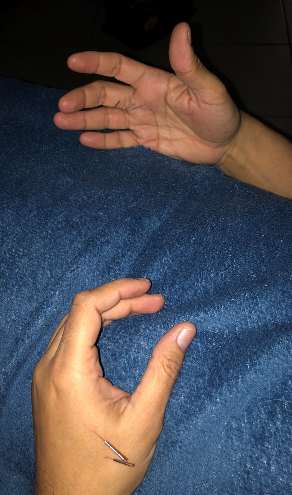 Séance d'acupuncture